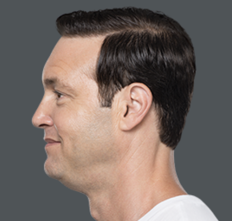 Kybella Before